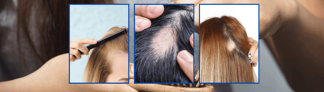 Opciones naturales para tratar la alopecia femenina